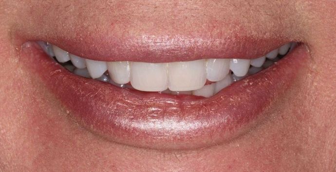 Invisalign Case 17 - After