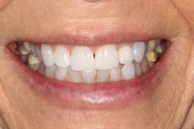 Invisalign Case 18 - Before