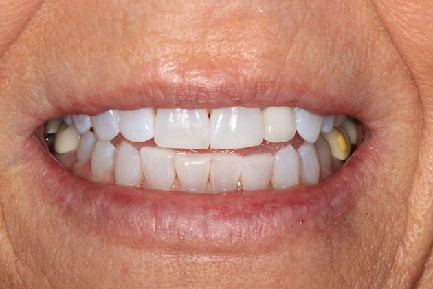 Invisalign Case 18 - After