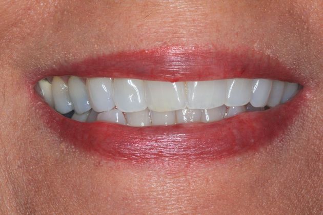 Invisalign Case 19 - Before