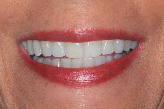 Invisalign Case 19 - After