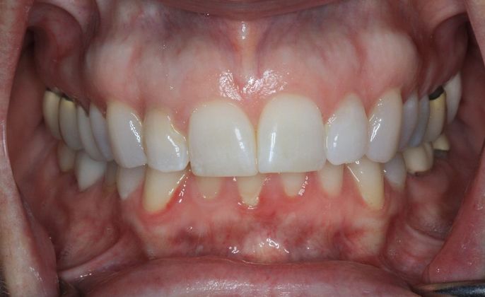 Porcelain Crowns: Case 15 - Before