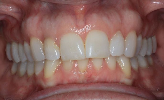 Porcelain Crowns: Case 15 - After