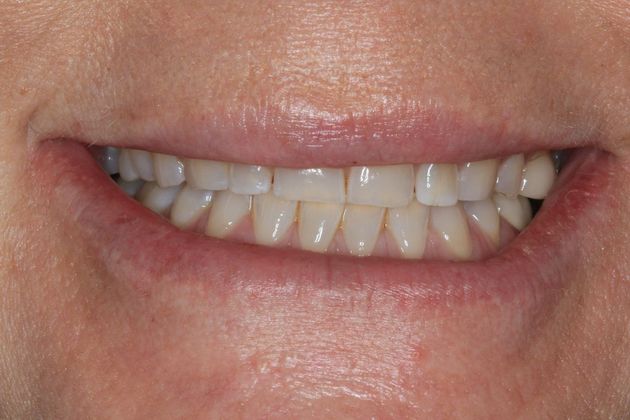 Full Mouth Reconstruction: Case 3 - Before