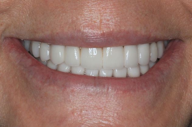 Full Mouth Reconstruction: Case 3 - After