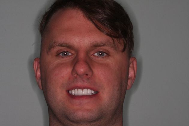 Porcelain Veneers: Case 26 - After Porcelain veneers