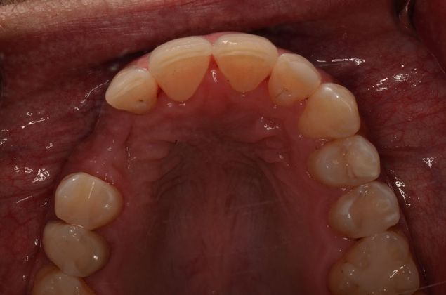Porcelain Veneers: Case 26 - Before Porcelain veneers