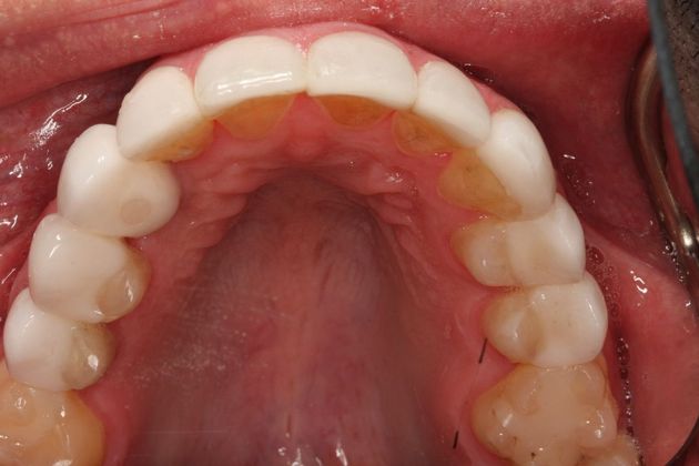 Porcelain Veneers: Case 26 - After implant placement