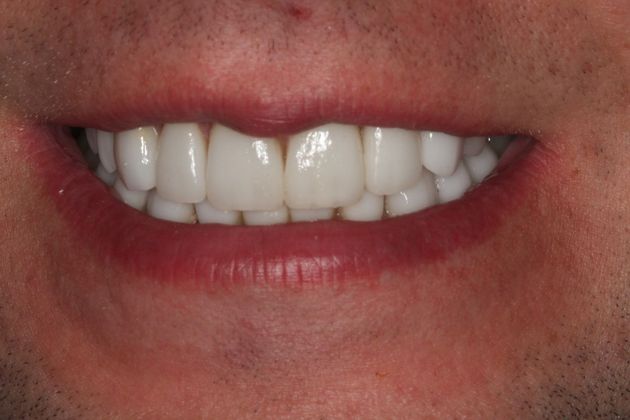 Porcelain Veneers: Case 26 - After Porcelain veneers