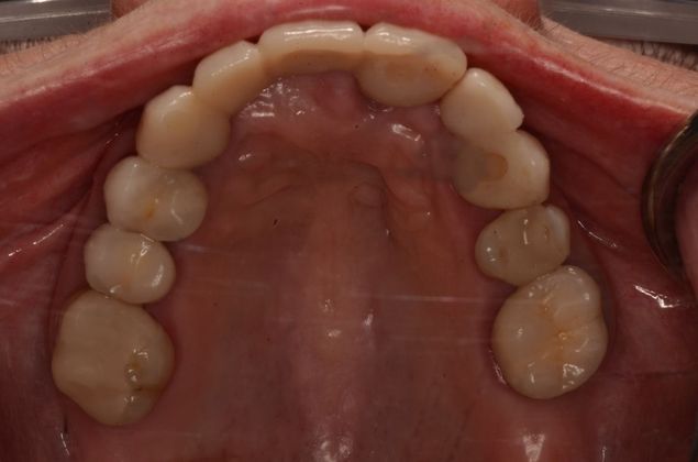 Bridges: Case 9 - After two implants and a new bridge