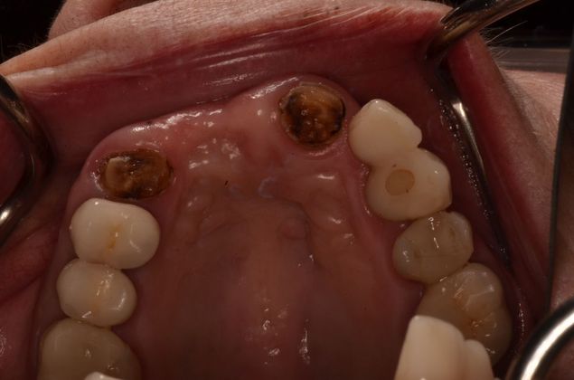 Dental Implants: Case 49 - Before extractions and implants