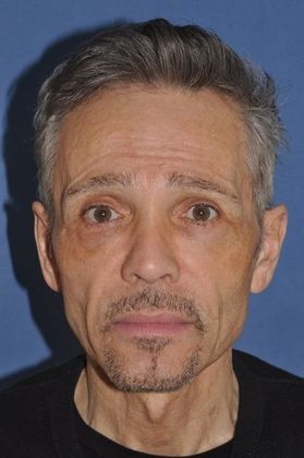 Facelift Case of male facelift - Before
