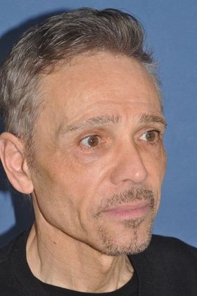 Endoscopic Browlift: Male with endoscopic browlift - Before