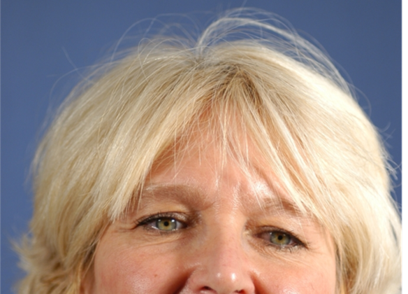 Endoscopic Browlift: 17 year follow up on an endoscopic browlift with eyelid surgery - Before