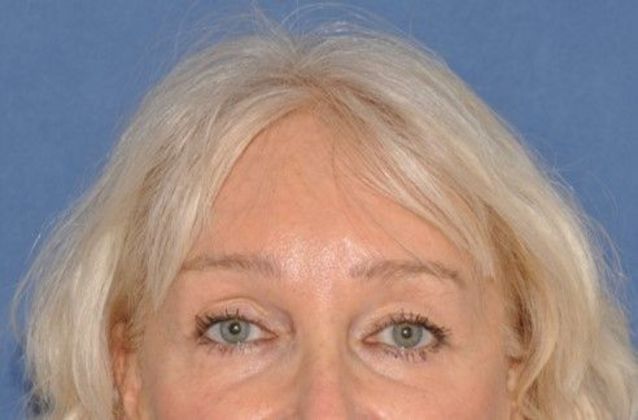 Endoscopic Browlift: 17 year follow up on an endoscopic browlift with eyelid surgery - After 17 years