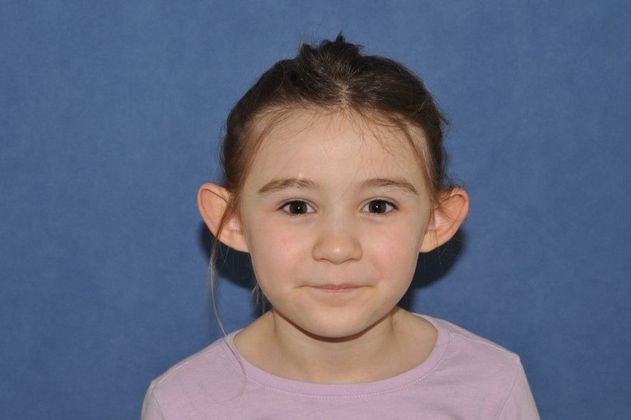 Otoplasty Otoplasty in a happy young lady! - Before