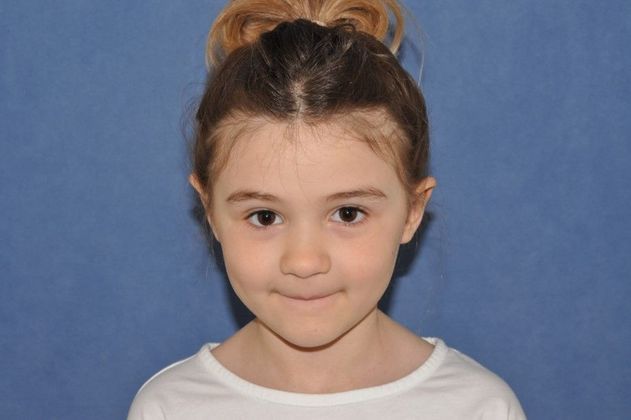 Otoplasty Otoplasty in a happy young lady! - After