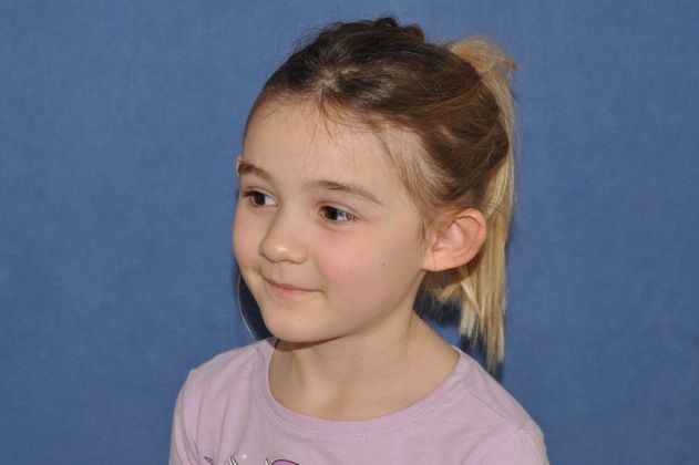 Otoplasty: Otoplasty in a happy young lady! - Before