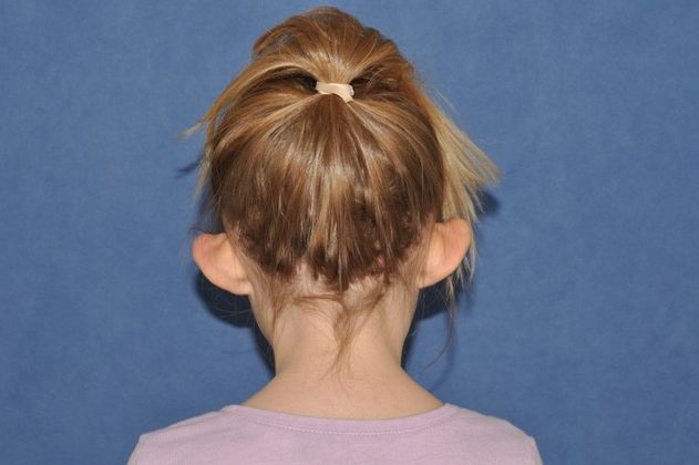 Otoplasty: Otoplasty in a happy young lady! - Before