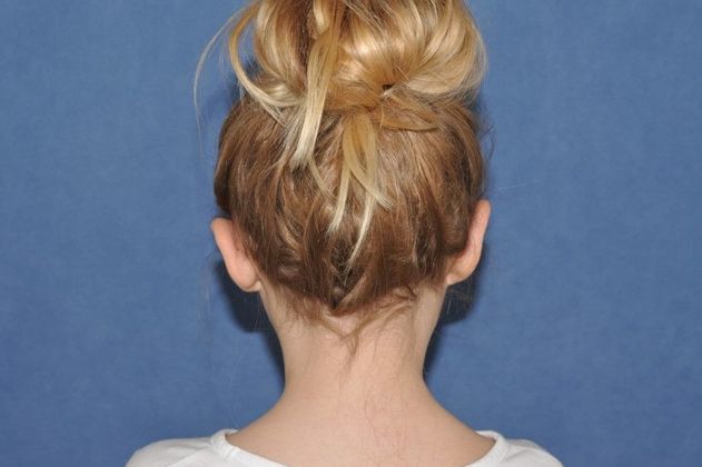 Otoplasty: Otoplasty in a happy young lady! - After