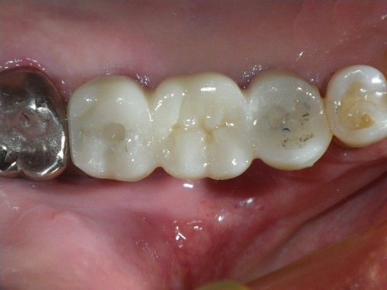 Dental Implants Cases