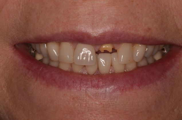 Dental Implants Case 50 - Before