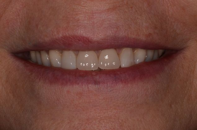Dental Implants Case 50 - After