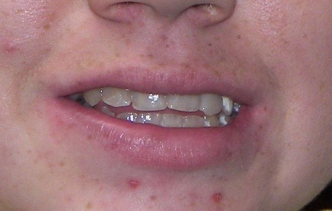 Cosmetic Changes with Veneers and Crown and Bridge: Case 4 - Before
