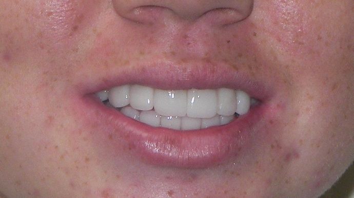 Cosmetic Changes with Veneers and Crown and Bridge: Case 4 - Before