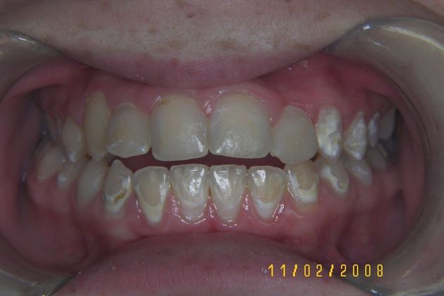 Cosmetic Changes with Veneers and Crown and Bridge: Case 4 - After