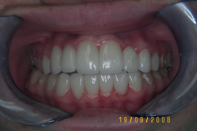 Cosmetic Changes with Veneers and Crown and Bridge: Case 4 - Before