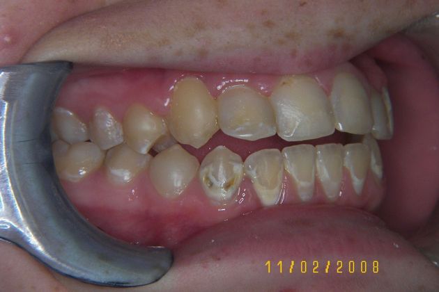 Cosmetic Changes with Veneers and Crown and Bridge: Case 4 - Before