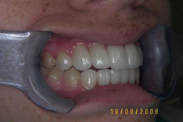 Cosmetic Changes with Veneers and Crown and Bridge: Case 4 - After