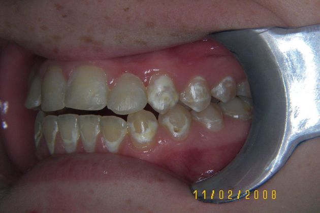 Cosmetic Changes with Veneers and Crown and Bridge: Case 4 - Before