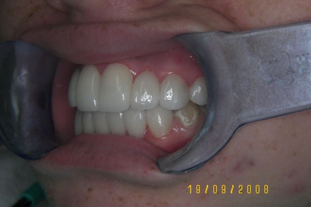 Cosmetic Changes with Veneers and Crown and Bridge: Case 4 - After