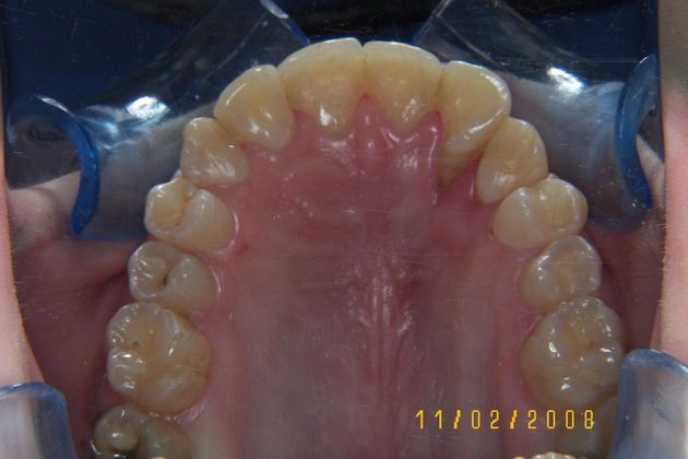 Cosmetic Changes with Veneers and Crown and Bridge: Case 4 - Before