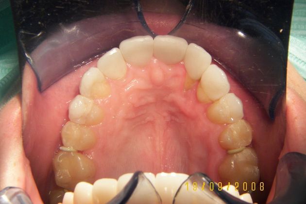 Cosmetic Changes with Veneers and Crown and Bridge: Case 4 - After