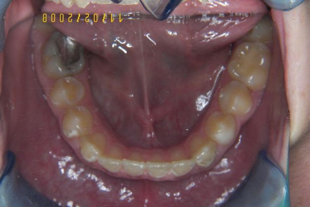 Cosmetic Changes with Veneers and Crown and Bridge: Case 4 - Before