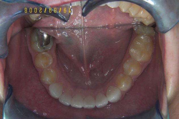 Cosmetic Changes with Veneers and Crown and Bridge: Case 4 - After