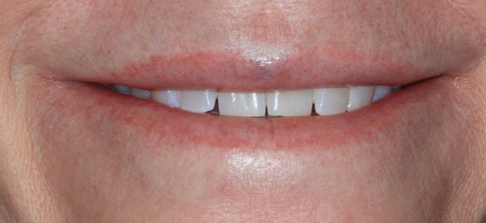 Bonding Case 7 - Before