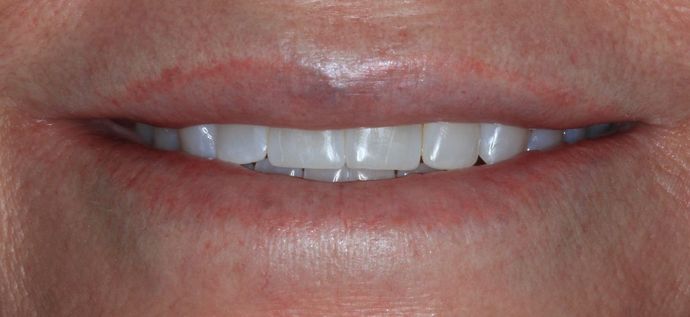 Bonding Case 7 - After