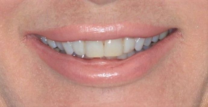 Bonding: Case 8 - Before