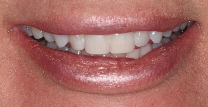 Bonding: Case 8 - After