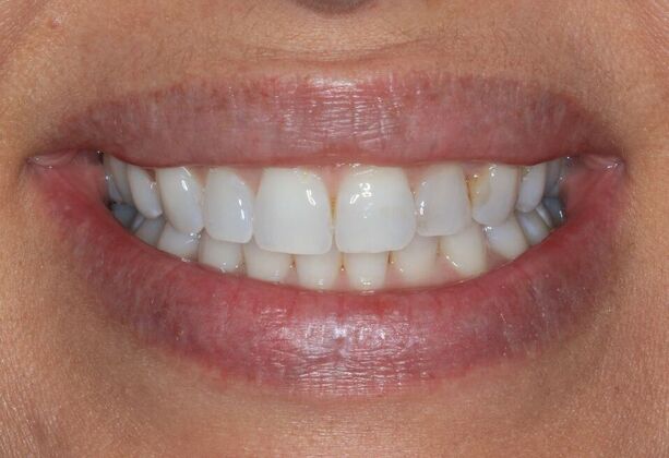 Bonding Case 9 - Before