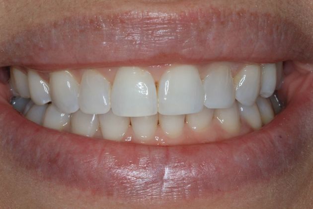 Bonding Case 9 - After