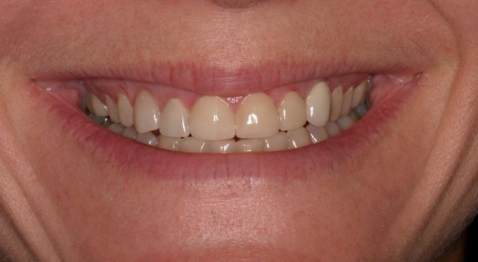 Full Mouth Reconstruction: Case 19 - Before