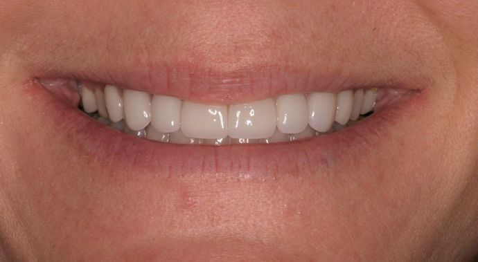 Full Mouth Reconstruction: Case 19 - After