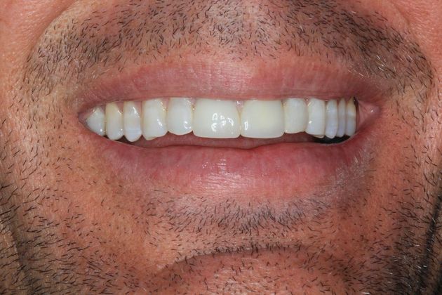Full Mouth Reconstruction: Case 20 - Before