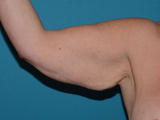 Arm Lift: Case 1 - Indianapolis - Before