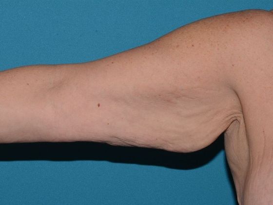 Arm Lift Case 1 - Indianapolis - Before